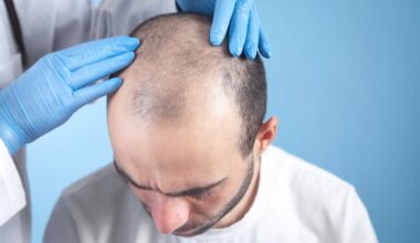 Jak długo trwa zabieg transplantacji włosów?